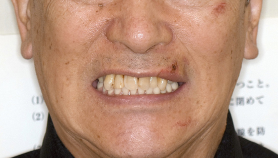 最終補綴物装着